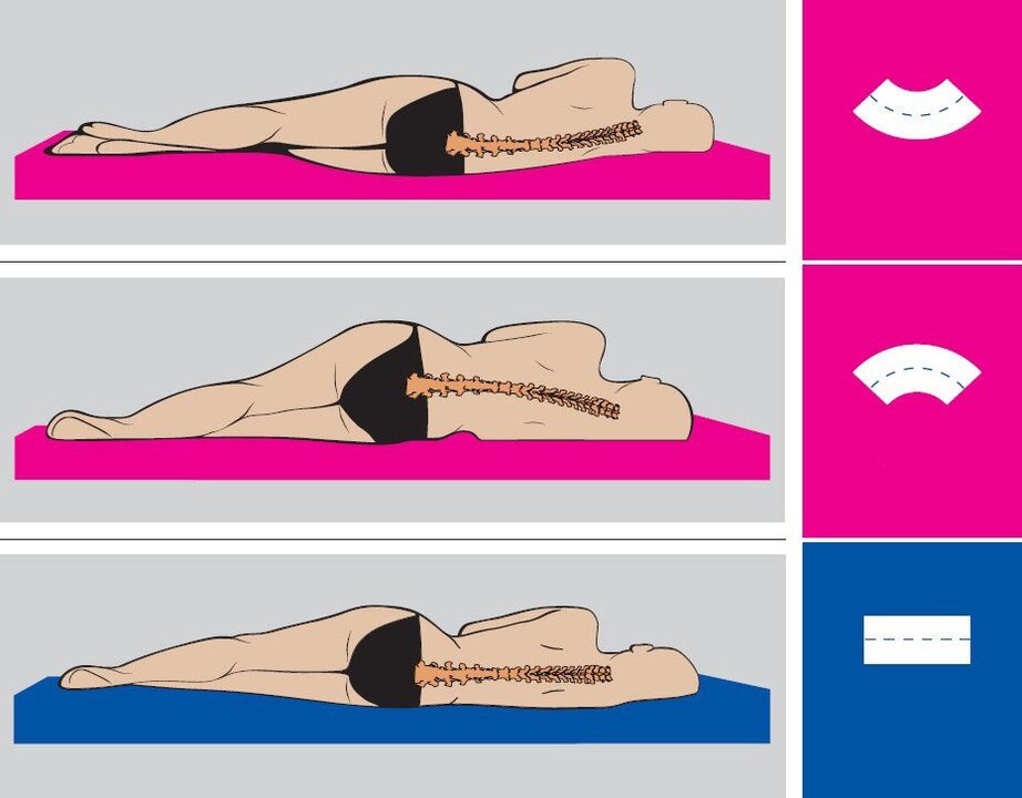 Správna poloha tela počas spánku s bedrovou osteochondrózou