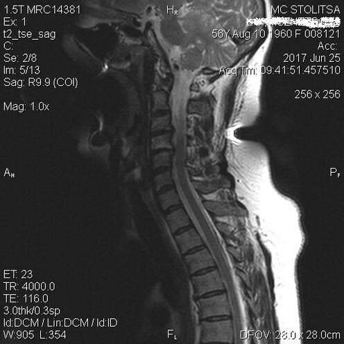 Osteochondróza a spondylóza krčnej chrbtice