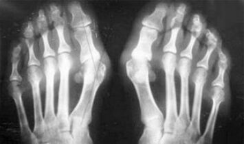 Diferenciálna diagnostika príznakov artritídy a artrózy